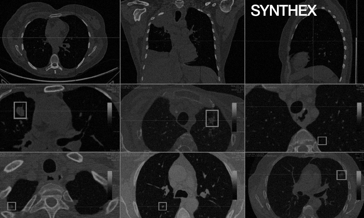 OPTIMIZING EARLY PREDICTION OF NSCLC USING AI IN NORTH AFRICAN HEALTHCARE